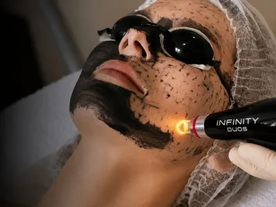 Aplicação do Infinity DUOS em protocolo Black Peel, com máscara de carvão ativado