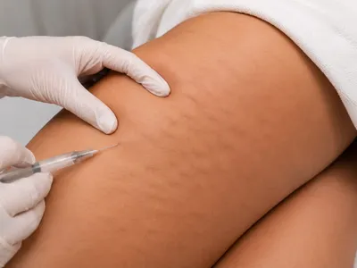 Aplicação da Carboxterapia em protocolo corporal para celulite