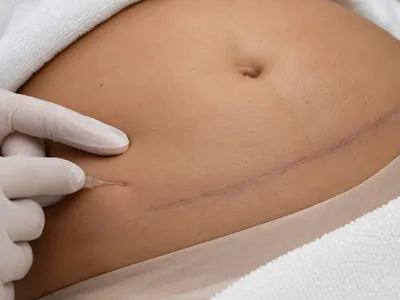 Aplicação da Carboxterapia em protocolo pós-operatório